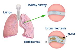 The Promise of New Treatments for Bronchiectasis