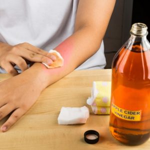 Does Apple Cider Vinegar help Granuloma Annulare