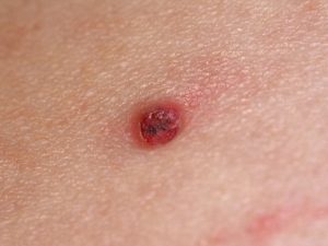 Does Drinking Alcohol make Granuloma Annulare worse