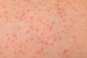 Folliculitis Home Treatment