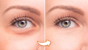 How to Remove Eye Bags Permanently in 5 Easy Steps