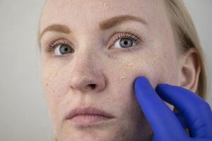 A woman examines dry skin on her face. Peeling, coarsening, disc