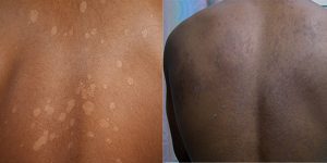 Is Tinea Versicolor the same as Eczema