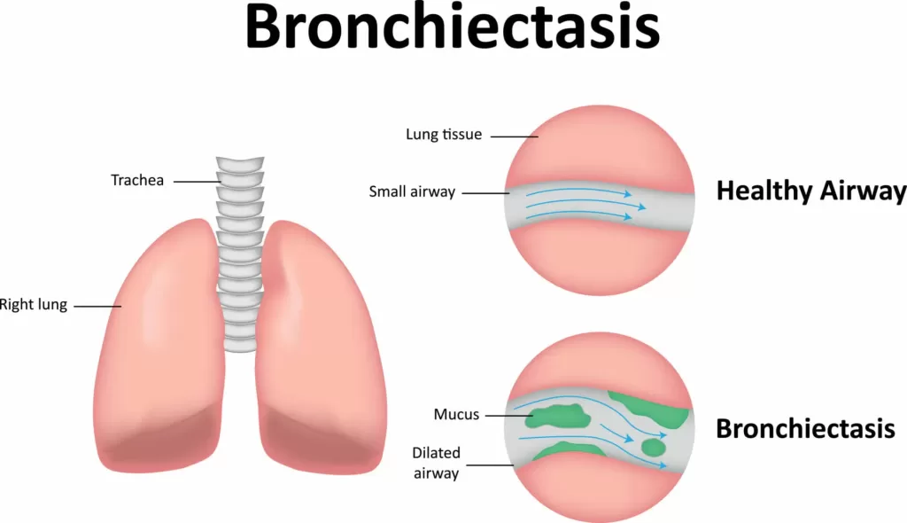 Bronchiectasis Herbal Supplement