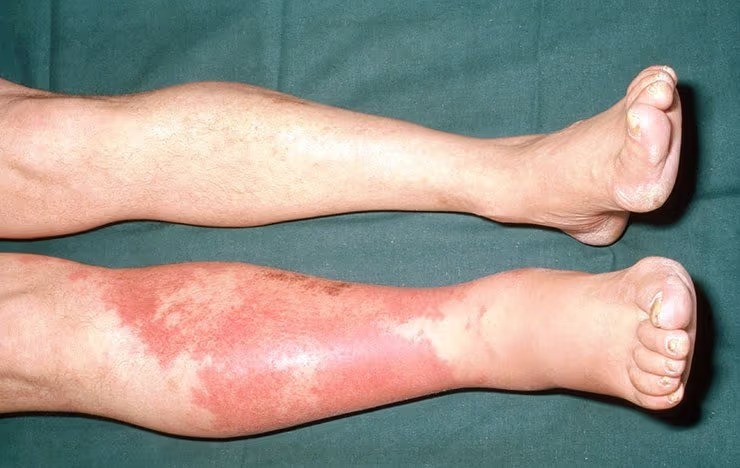 Cellulitis Infection