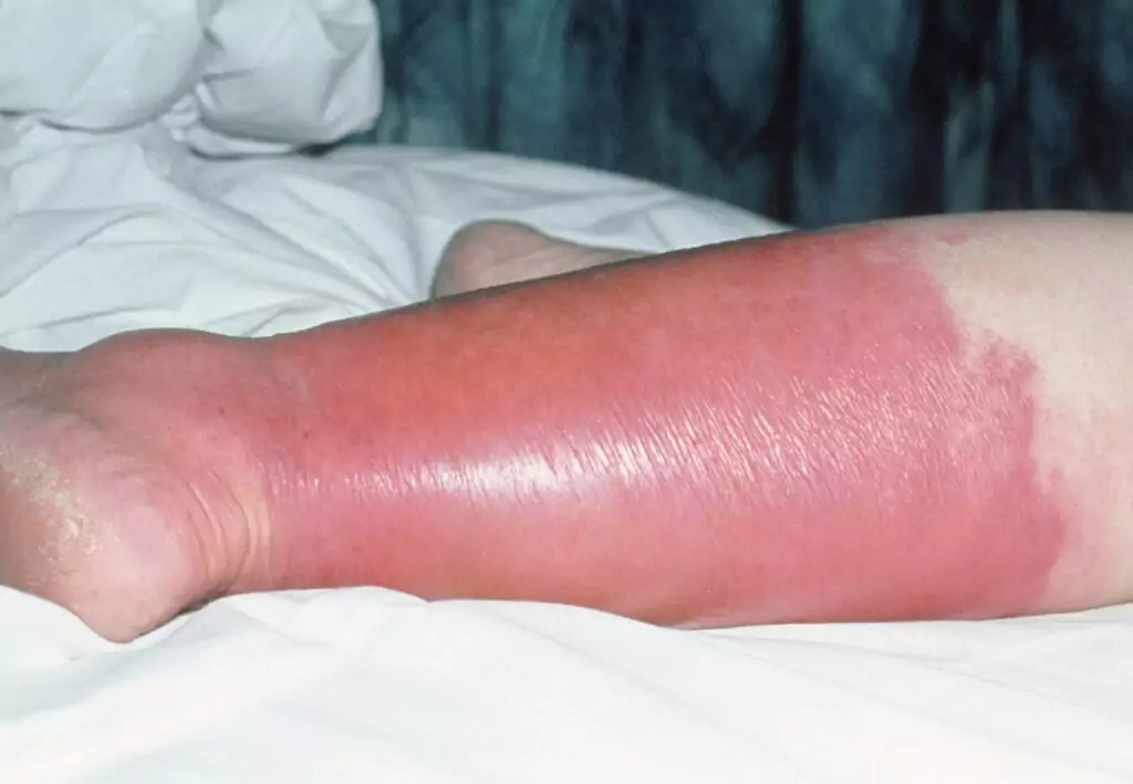 Effective Cellulitis Treatments