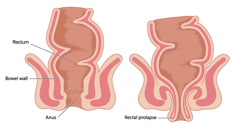 How to Treat Rectal Prolapse Without Surgery