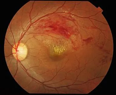 Revolutionizing the Treatment of Retinal Vein Occlusion