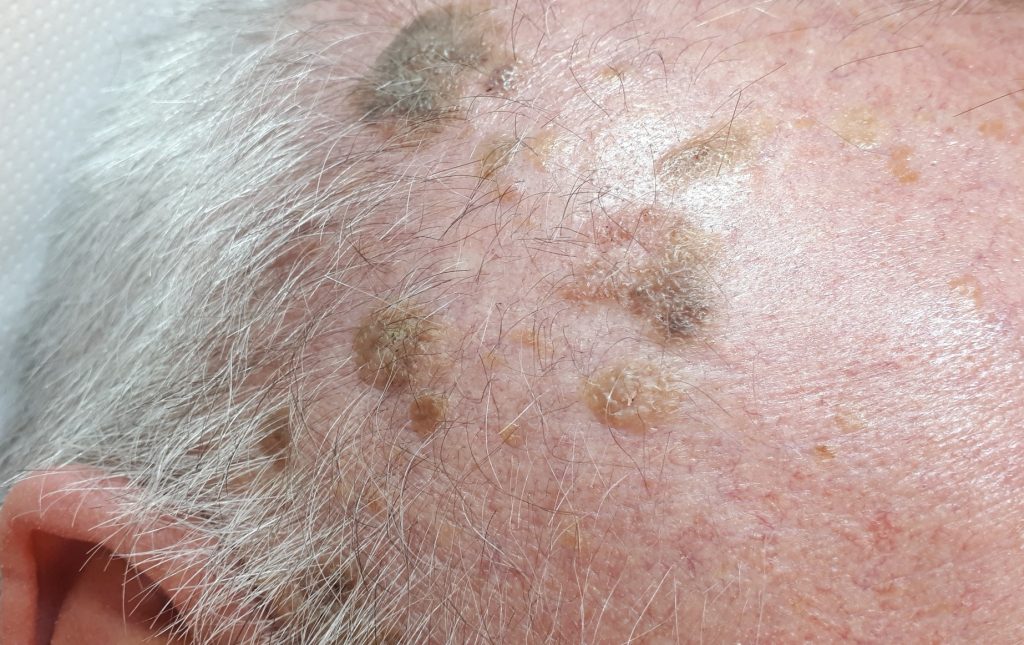 Seborrheic Keratosis The Easiest Way to Remove at Home